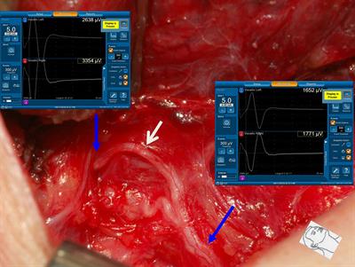 Necessity of Routinely Testing the Proximal and Distal Ends of Exposed Recurrent Laryngeal Nerve During Monitored Thyroidectomy